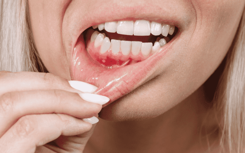Close up of bleeding gums during oral care
