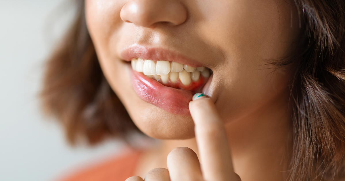 Close up of gums showing early signs of gum disease
