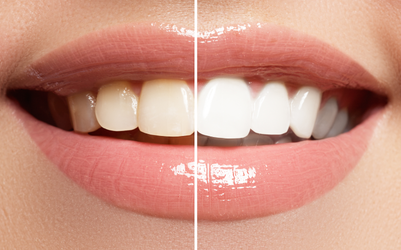 Smile before and after teeth whitening treatment