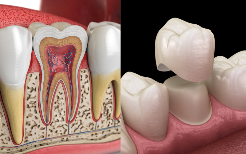Illustration of a root canal vs dental crown