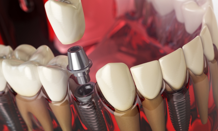 Close up of a dental implant restoration