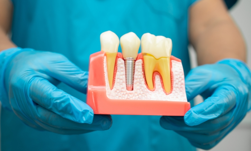 Dental implant procedure model on a blue background