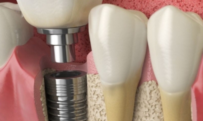 Dental implant with bone grafting illustration
