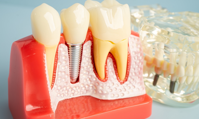 Illustration of a dental implant replacing a missing tooth