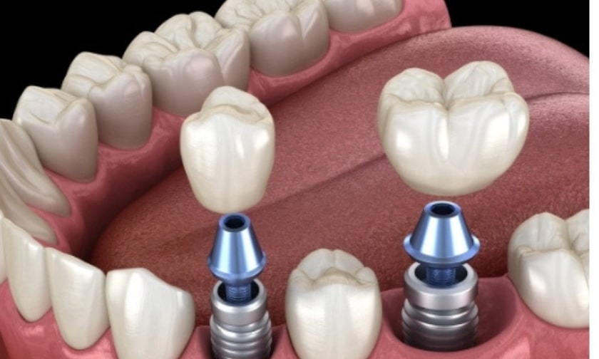 Illustration of smoking and vaping effects on dental implants