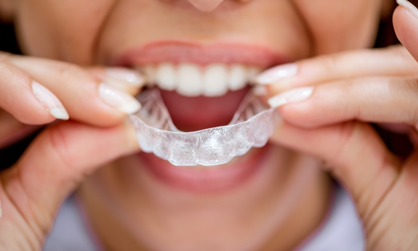 Adult patient with crowded teeth using clear aligners