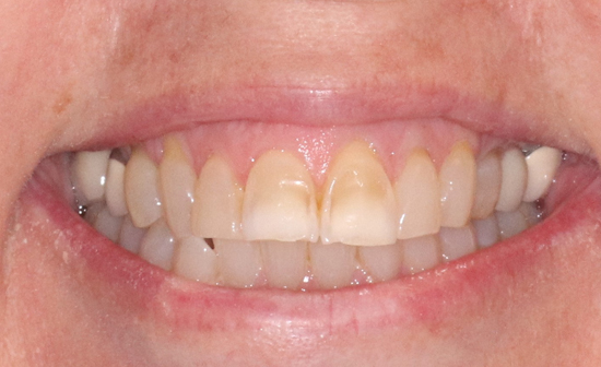Dental bridge restoring missing teeth