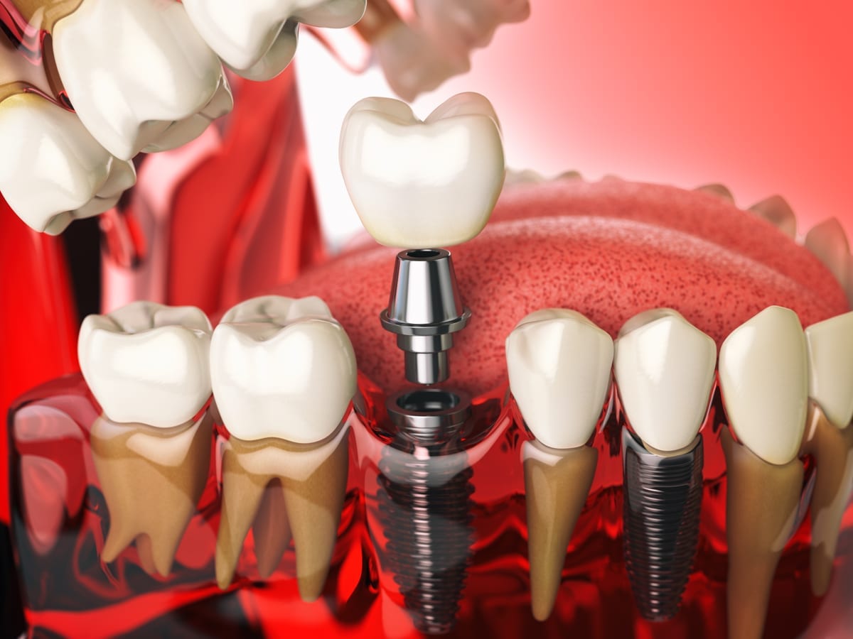 Illustration of dental implants