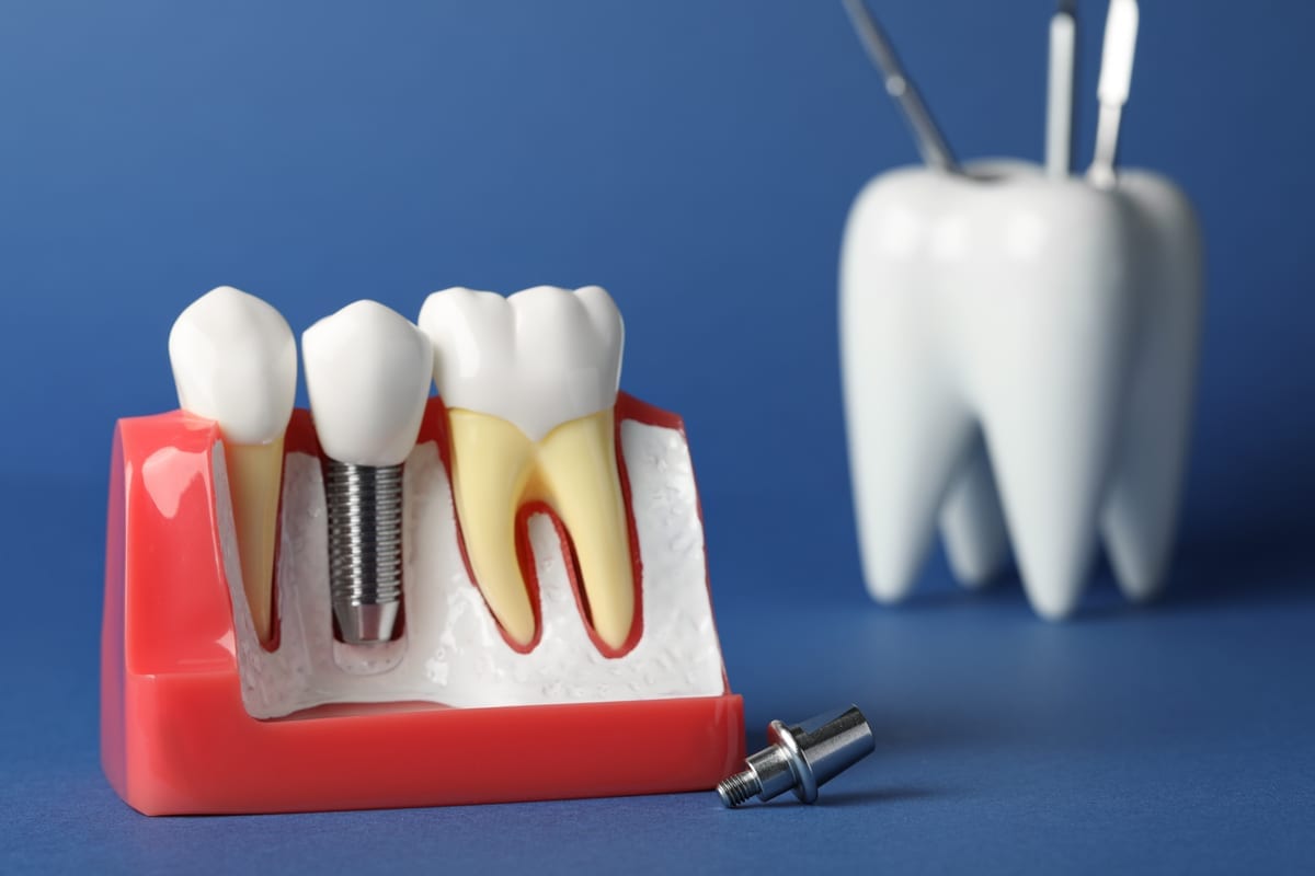 Illustration of a completed dental implant restoration