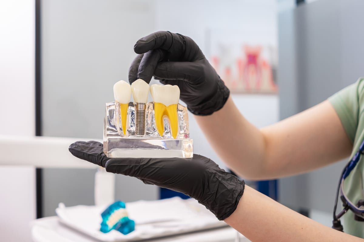 Dental implant components prepared for treatment