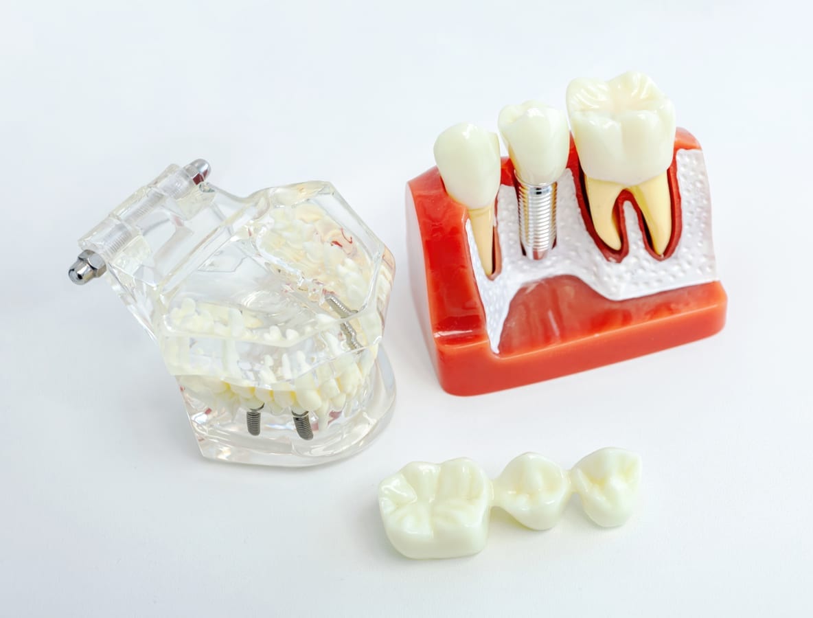 Dental implant models placed on a white background