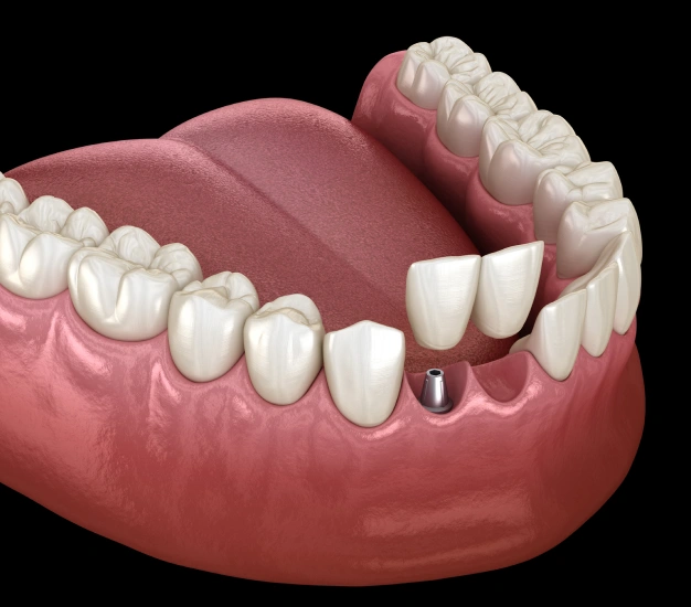 Illustration of cantilever dental bridges
