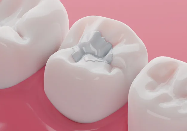 Close up of tooth model with a composite filling