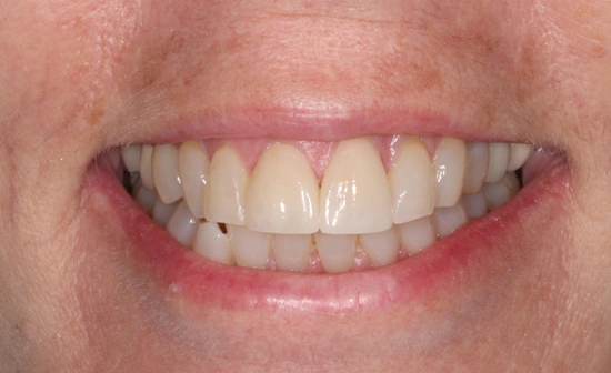 Dental crown after treatment with restored teeth