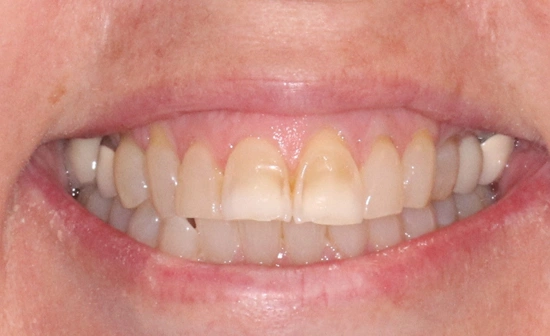 Dental crown before treatment on front teeth