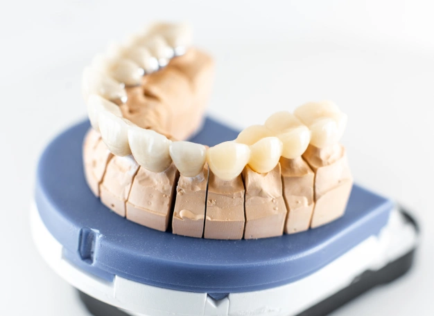 Dental bridge model