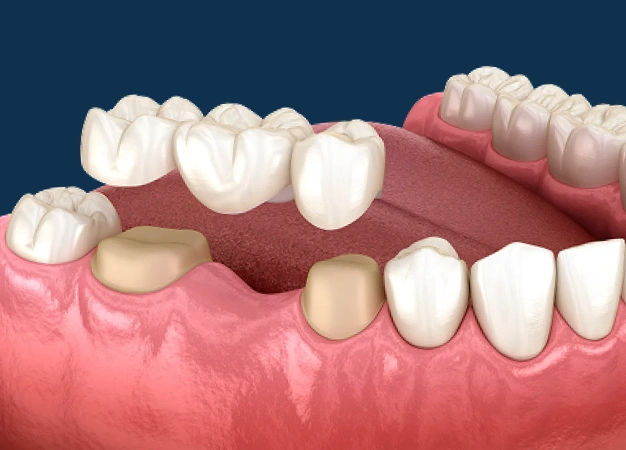 Illustration of a dental bridge replacing missing teeth