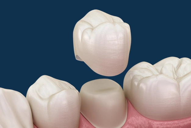 Dental crown restoration displayed on a blue background
