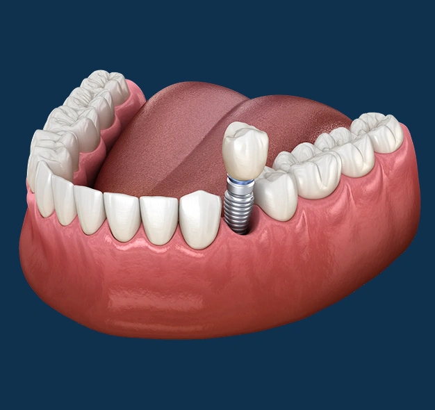 Illustration of dental implants