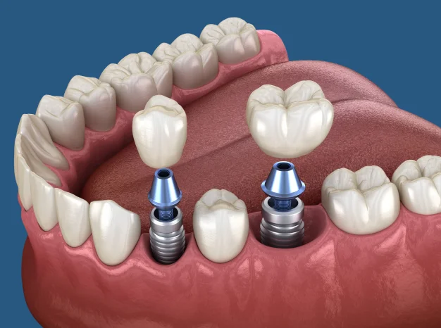 Illustration of a dental implant procedure in the jaw