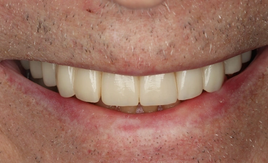 Denture patient after restorative treatment