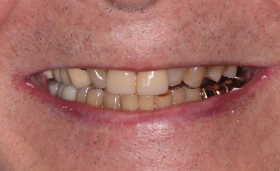 Denture patient before restorative treatment
