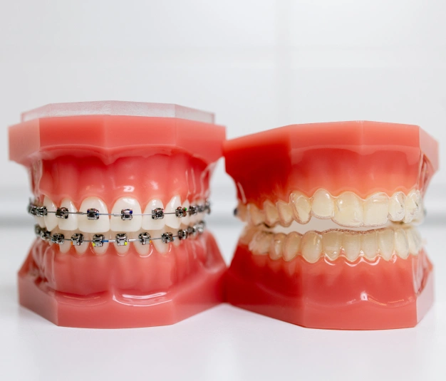 Two models showing difference between invisalign and braces