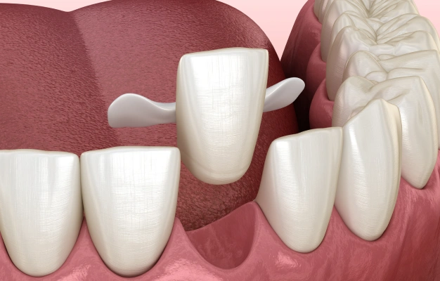Illustration of dental bridges