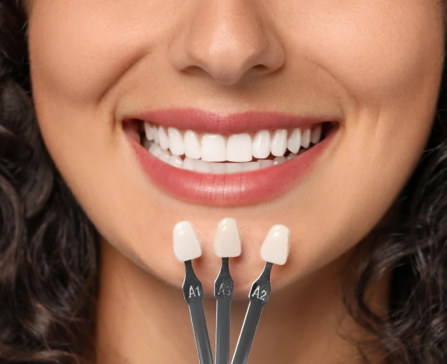 Close up of veneers and a smiling woman
