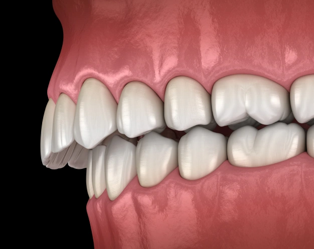 Illustration of overbites