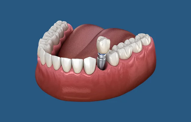 Illustration of a single tooth dental implant
