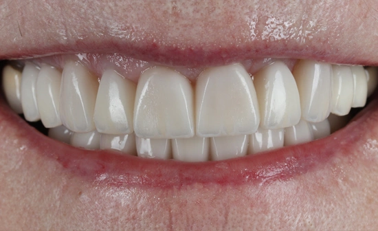 Crowded teeth after treatment with improved alignment