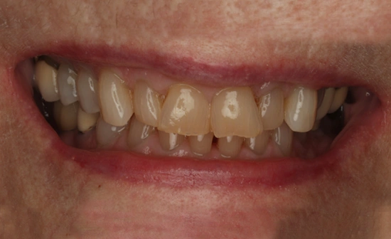Crowded teeth before treatment