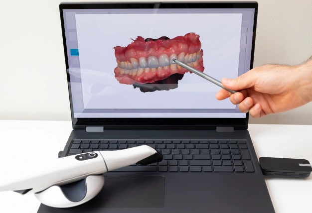 Digital intraoral scanner displaying a 3D dental model