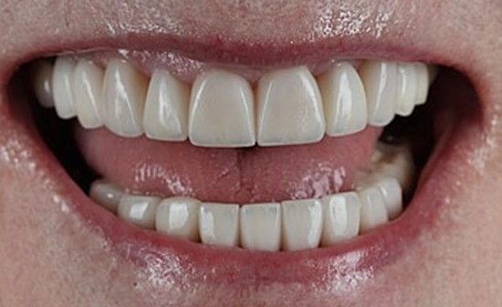 Teeth alignment after orthodontic treatment