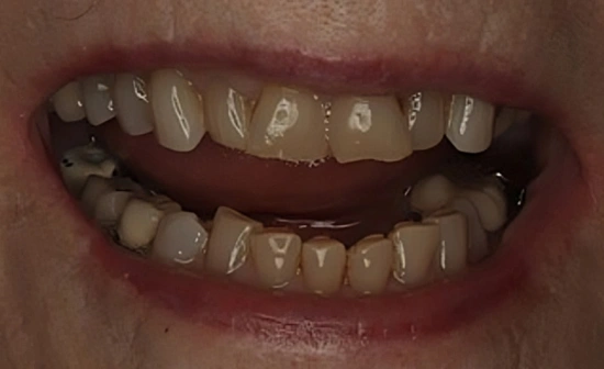 Teeth alignment before orthodontic treatment