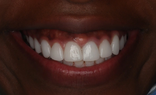 Teeth whitening after treatment with a brighter smile