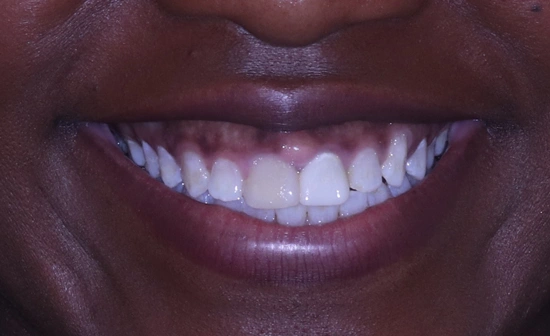 Teeth whitening before treatment with stained teeth