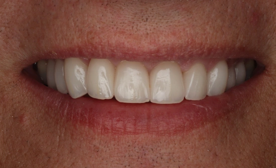Dental veneers after cosmetic smile enhancement