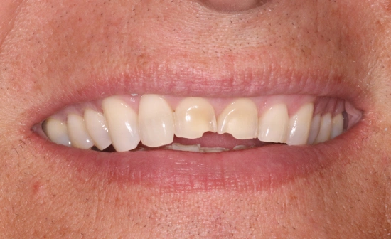 Dental veneers before cosmetic treatment