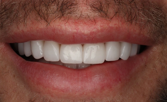 Teeth whitening after treatment with brighter teeth