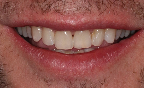 Teeth whitening before treatment showing tooth discoloration