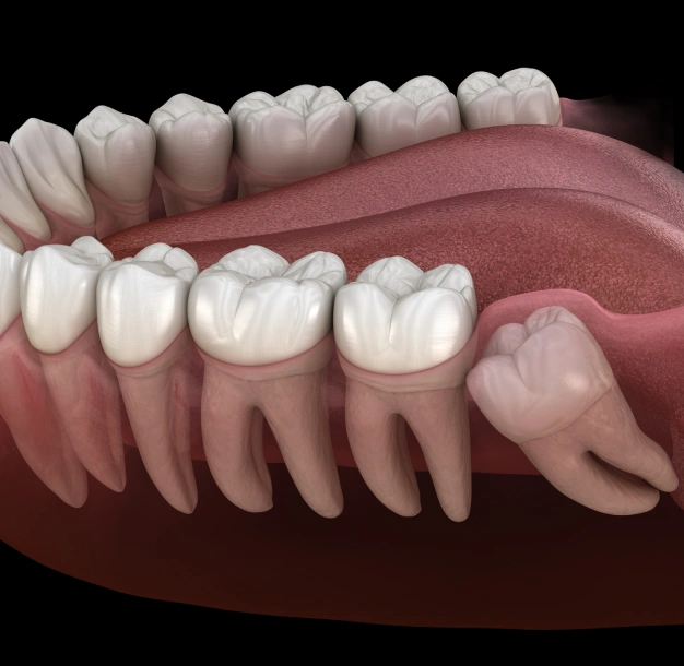 Illustration of wisdom tooth removal and impacted tooth
