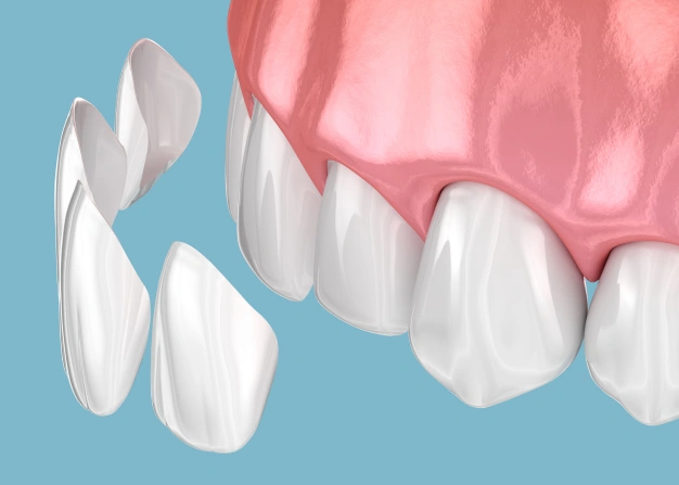 Illustration of veneers