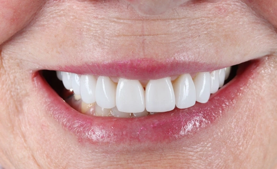 Porcelain veneers after treatment with enhanced smile