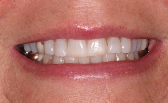 Porcelain veneers before treatment showing natural teeth