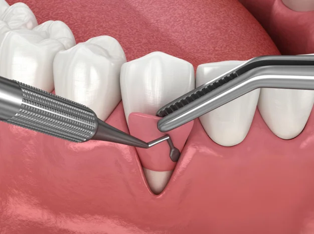 Illustration of a dental bone and gum grafting procedure using dental instruments around the teeth.